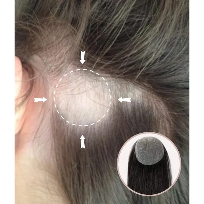 Full Skin Base Cover Up Hair Patches Pieces No Surgical Solution For Alopecia Areata